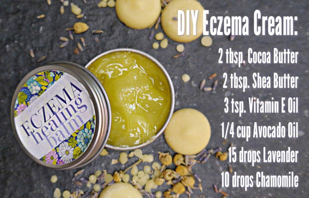 DIY Eczema Cream